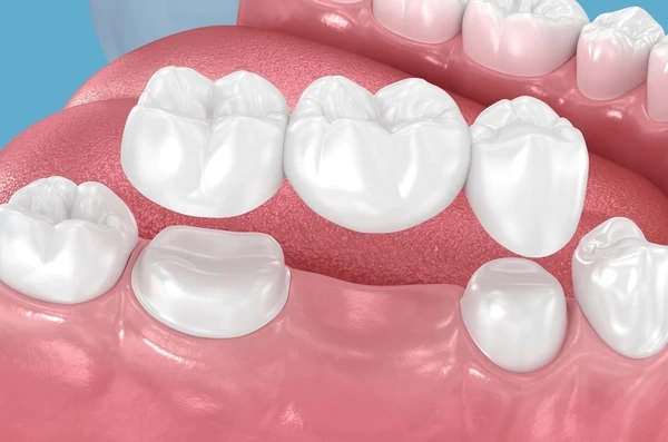 dental bridges near you
