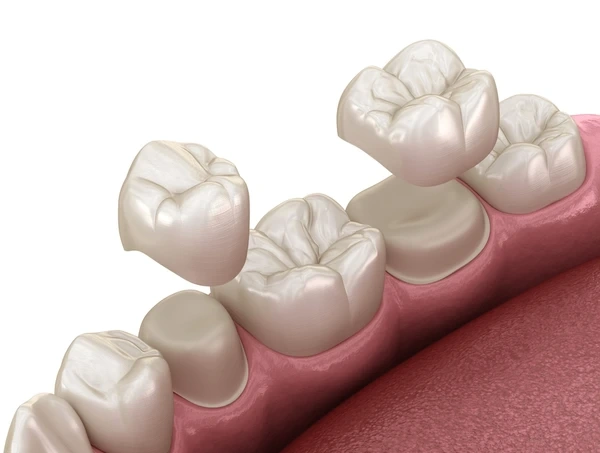 dental crowns near you