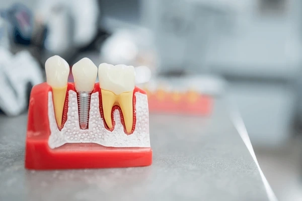 dental implants in marpole bc