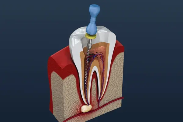 root canal treatment in marpole bc