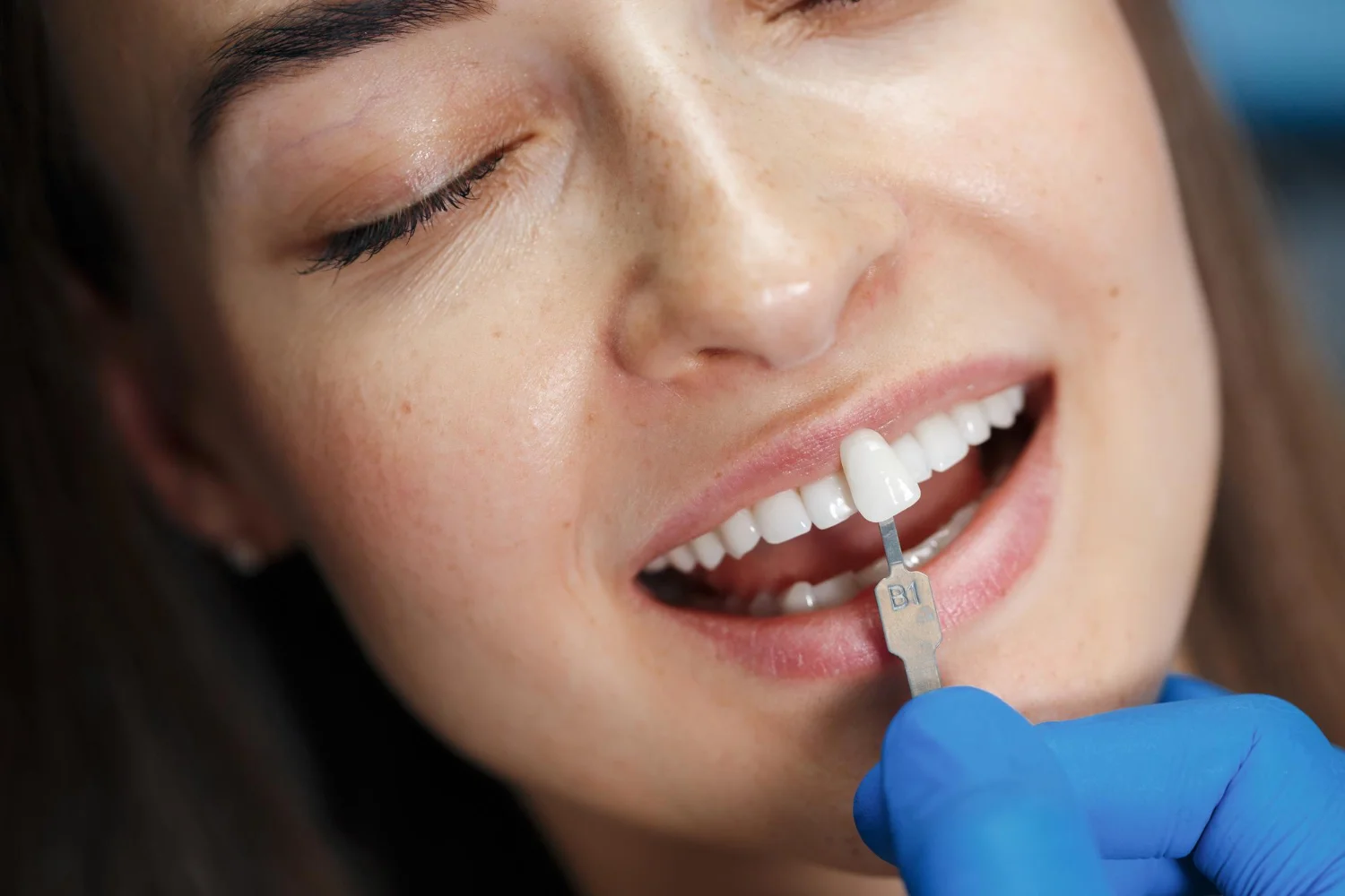 minish dental veneer near you