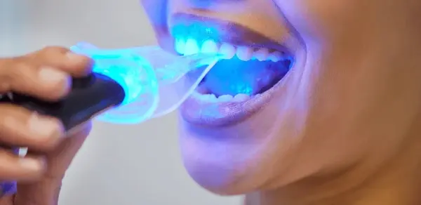 zoom whitening in marpole bc